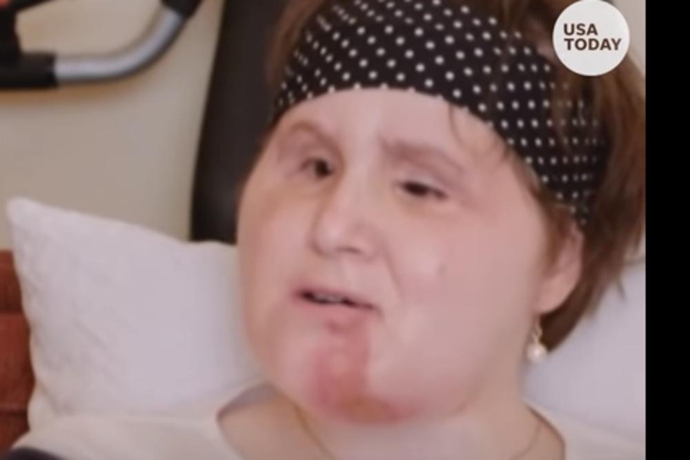 PUCALA JE SEBI U GLAVU, I PREŽIVELA: Sada je postala NAJMLAĐA osoba kojoj su u SAD presadili LICE! (VIDEO)