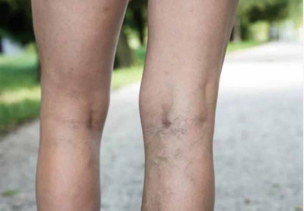 Kakve sve kompresivne čarape postoje i koliko pomažu kod proširenih vena?