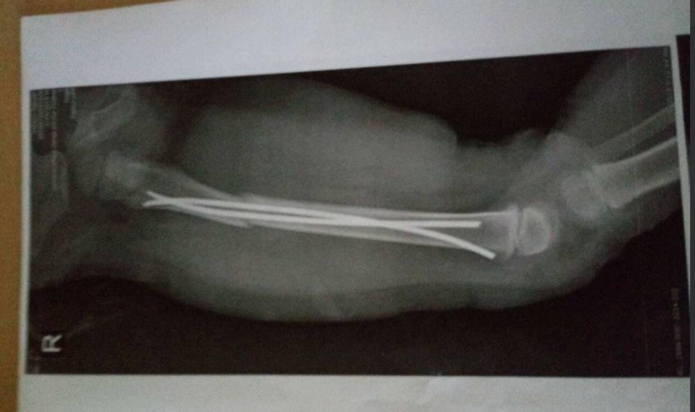 OGNJENA(3) JE UDARIO BICIKLISTA NAKON ČEGA JE DOŽIVEO PRELOM BUTNE KOSTI  