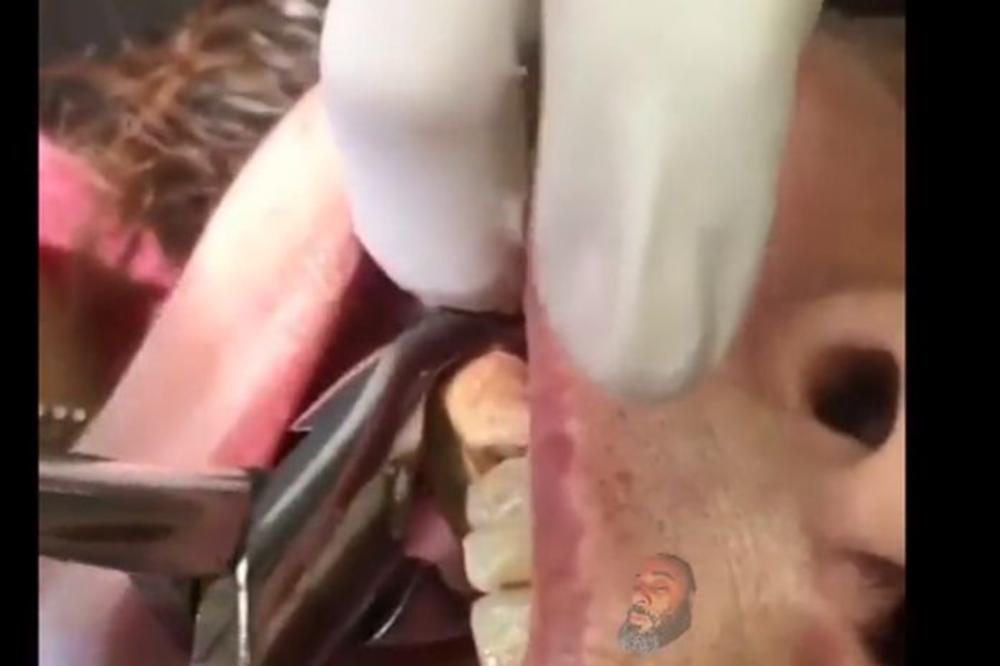 NAJGORI SLUČAJ KAMENCA U ISTORIJI: Gledate na sopstveni želudac! (VIDEO)