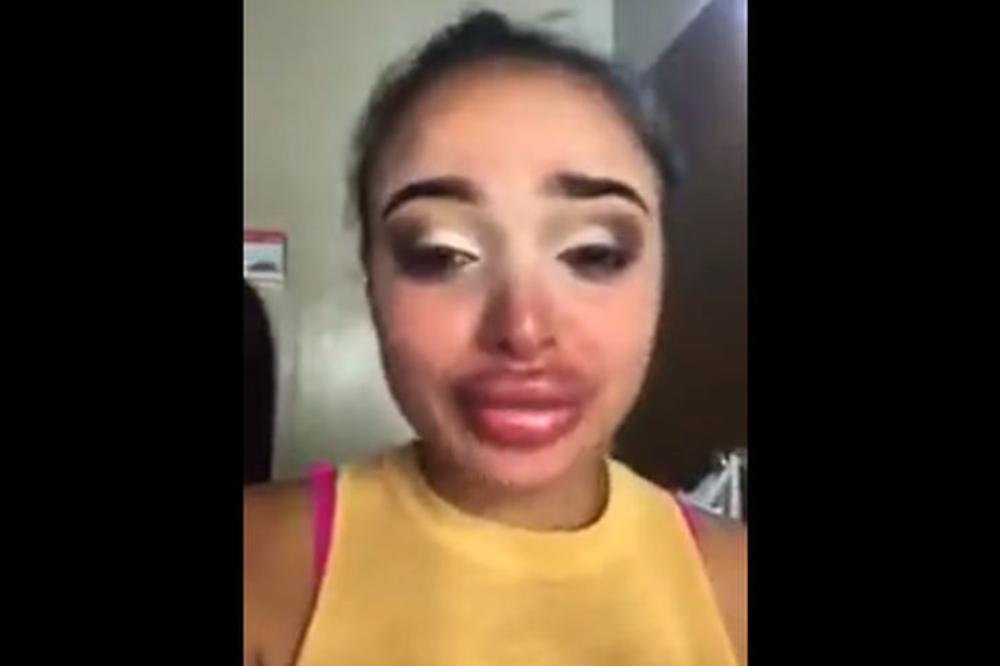 UNIŠTILI STE MI ŽIVOT! Devojka u suzama posle plastične operacije usana! (VIDEO)