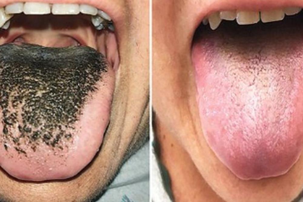 UZIMALA JE JAKE ANTIBIOTIKE, a onda je doživela ŠOK kad je pogledala u ogledalo!