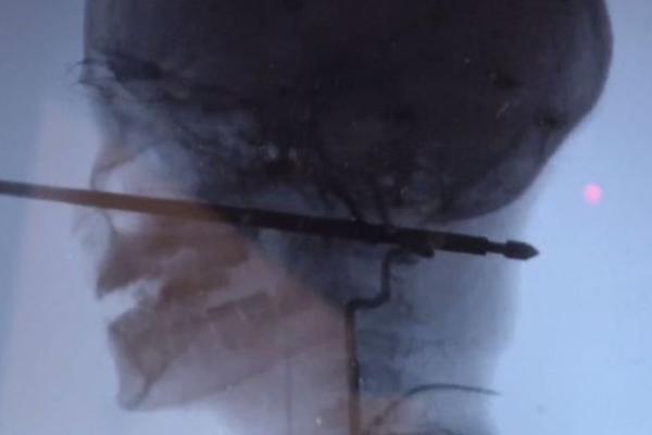 NAPALE SU GA OSICE, PA JE PAO GLAVOM PRAVO NA RAŽANJ! Dečak (10) je uspeo da preživi neverovatnu povredu! (VIDEO)