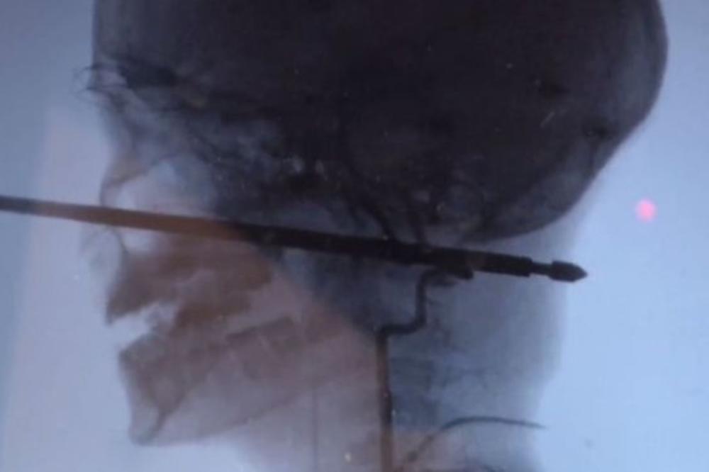 NAPALE SU GA OSICE, PA JE PAO GLAVOM PRAVO NA RAŽANJ! Dečak (10) je uspeo da preživi neverovatnu povredu! (VIDEO)