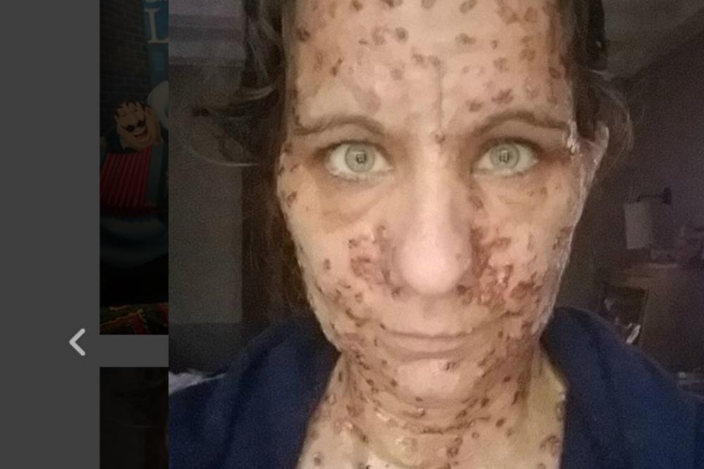 ZVALI SU JE DAH GUŠTERA, IMALA JE 6.000 IZRASLINA PO TELU: Dobacivali su joj gadosti, niko nije hteo da je zaposli, sada se operisala i izgleda ovako! (FOTO)