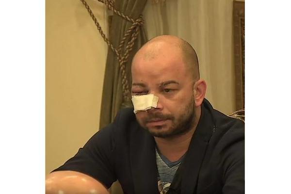 DRAMA U PAROVIMA: Ja jesam izazvao Luku na neki način, ali ne da ovako zverski prođem!Evo kako Mili izgleda!(FOTO)