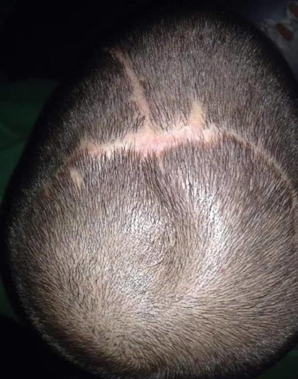 Milan Mitić, povreda glave  