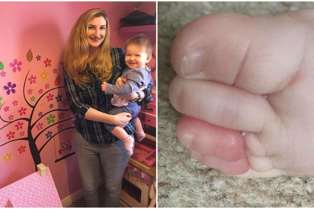 BEBA JE DANIMA PLAKALA, A ONDA SU JOJ SKINULI ČARAPE I VIDELI HOROR! Zbog ovog je mogla da ostane bez PRSTA