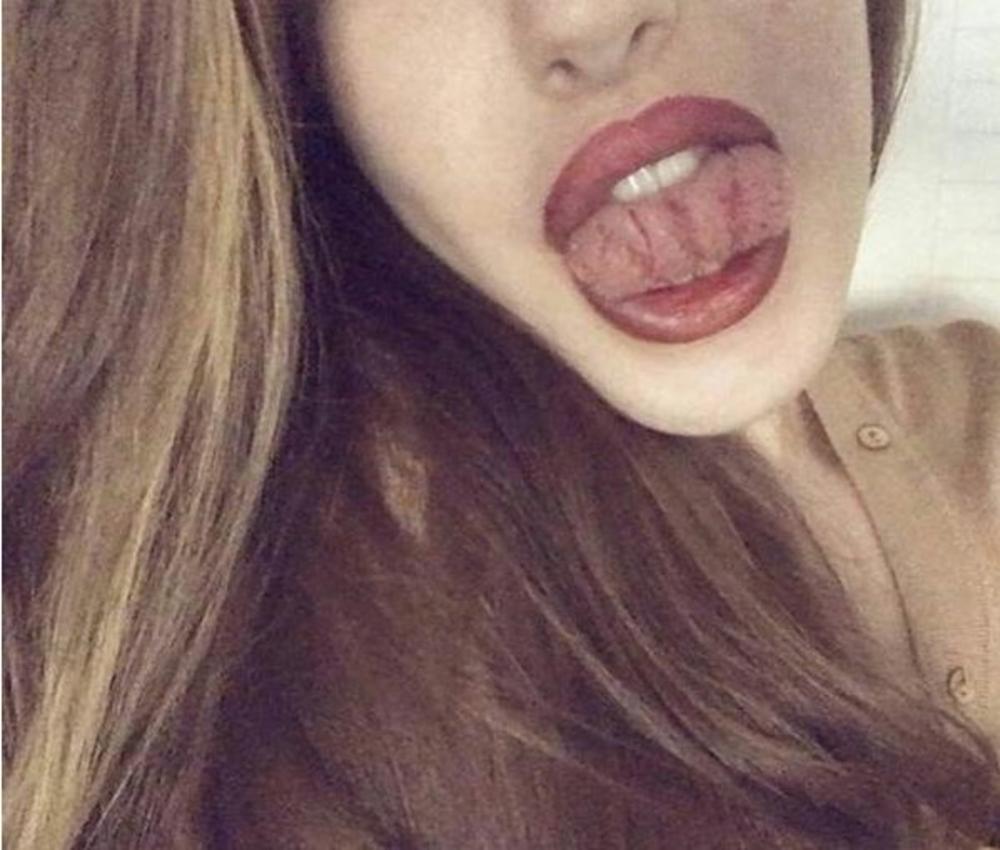 Izbrazdani jezik označava upalno stanje  