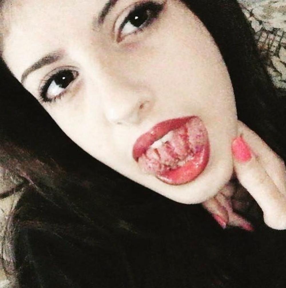 Brazde mogu da menjaju mesto, a obično ih prati peckanje i nelagodnost  