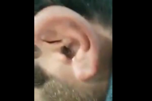 ŽALIO SE DA MU JE NEŠTO UŠLO U UVO: Lekar mu je sipao kapi,i izašlo je nešto baš GADNO! (VIDEO)