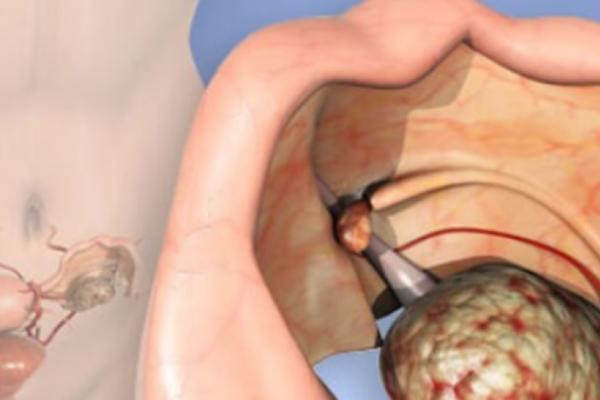 LEK KOJI SVAKO IMA U KUĆI, ŽENAMA MOŽE DA SPASI ŽIVOT! Od ove BOLESTI ne mora da se UMRE!