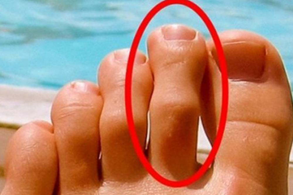 ODMAH SKINITE ČARAPE I POGLEDAJTE: Ako vam je DRUGI prst duži od svih ostalih, TO NIJE ZA DŽABE!