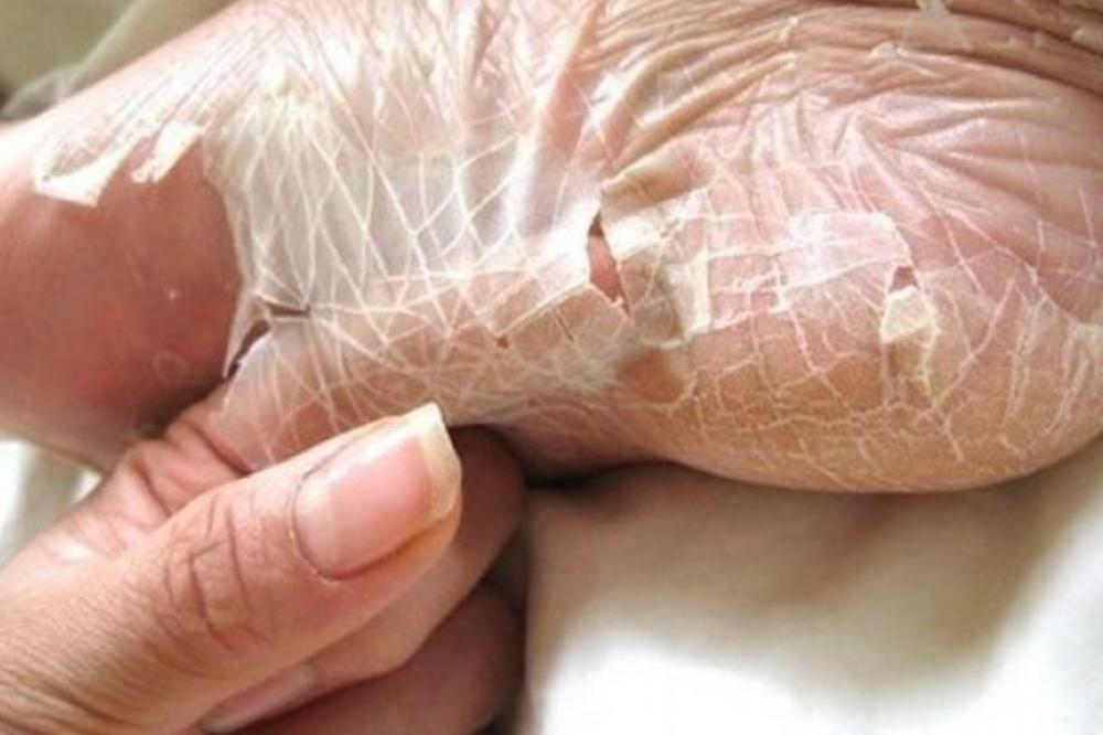 SRPKINJA JE PROBALA MASKU ZA STOPALA, A NAKON 15 DANA OTPALA JOJ JE PETA: Stopala joj sada izgledaju DRUGAČIJE