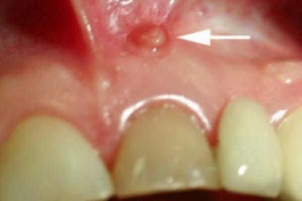 IMATE FISTULU NA ZUBNOM MESU? Telo pokušava da vas upozori na nešto, nemojte zanemarivati ovaj SIMPTOM!