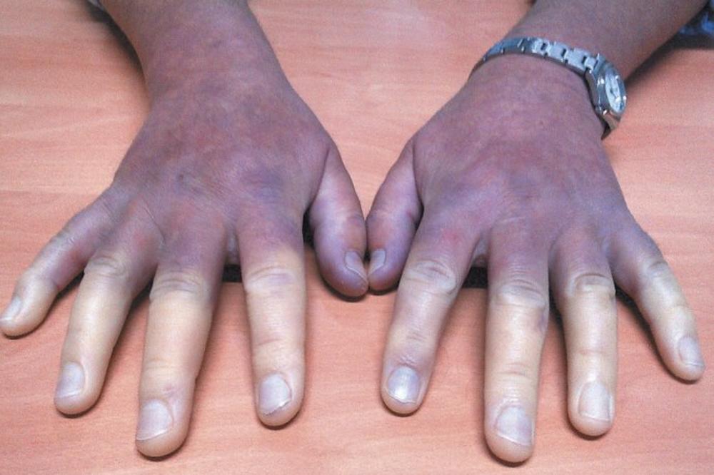 RUKE I NOGE SU VAM STALNO HLADNE? To nije uopšte BEZAZLENO, može ukazivati na brojne OPASNE BOLESTI!