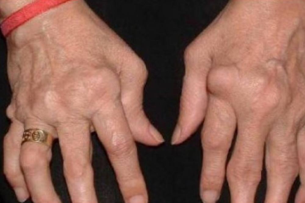 RAZLOG VAŠE REUME JE U FRIŽIDERU! Jedete je svaki dan, a sadrži OPASNU BAKTERIJU koja ubrzava ovu bolest