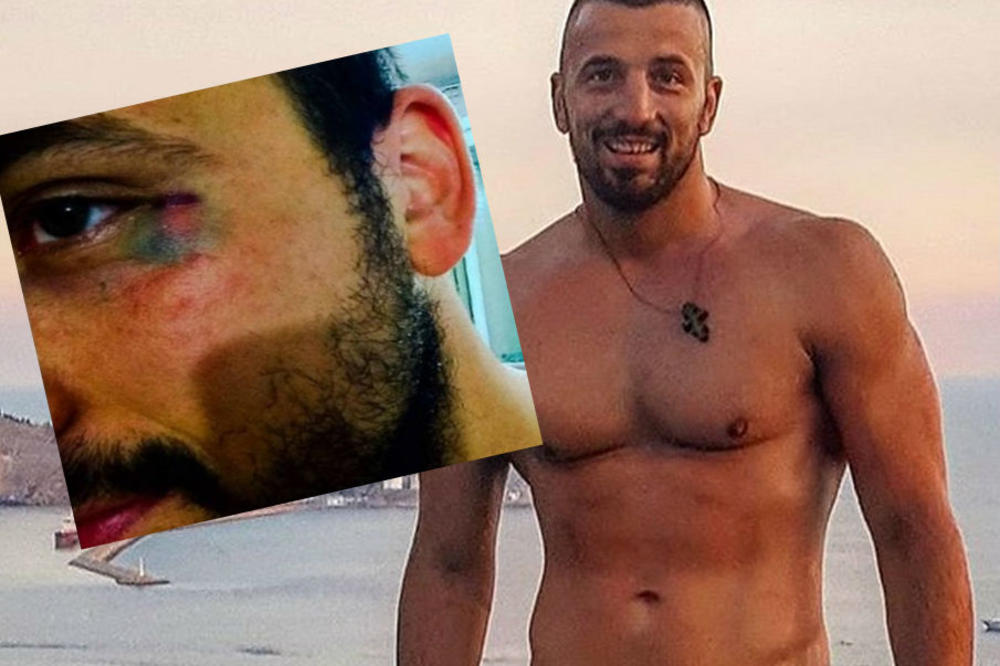 MENE NI 20 TAMO FANOVA NE MOŽE DA PREBIJE! Tomović objavio fotku sa PODLIVIMA I MODRICAMA i otkrio ISTINU