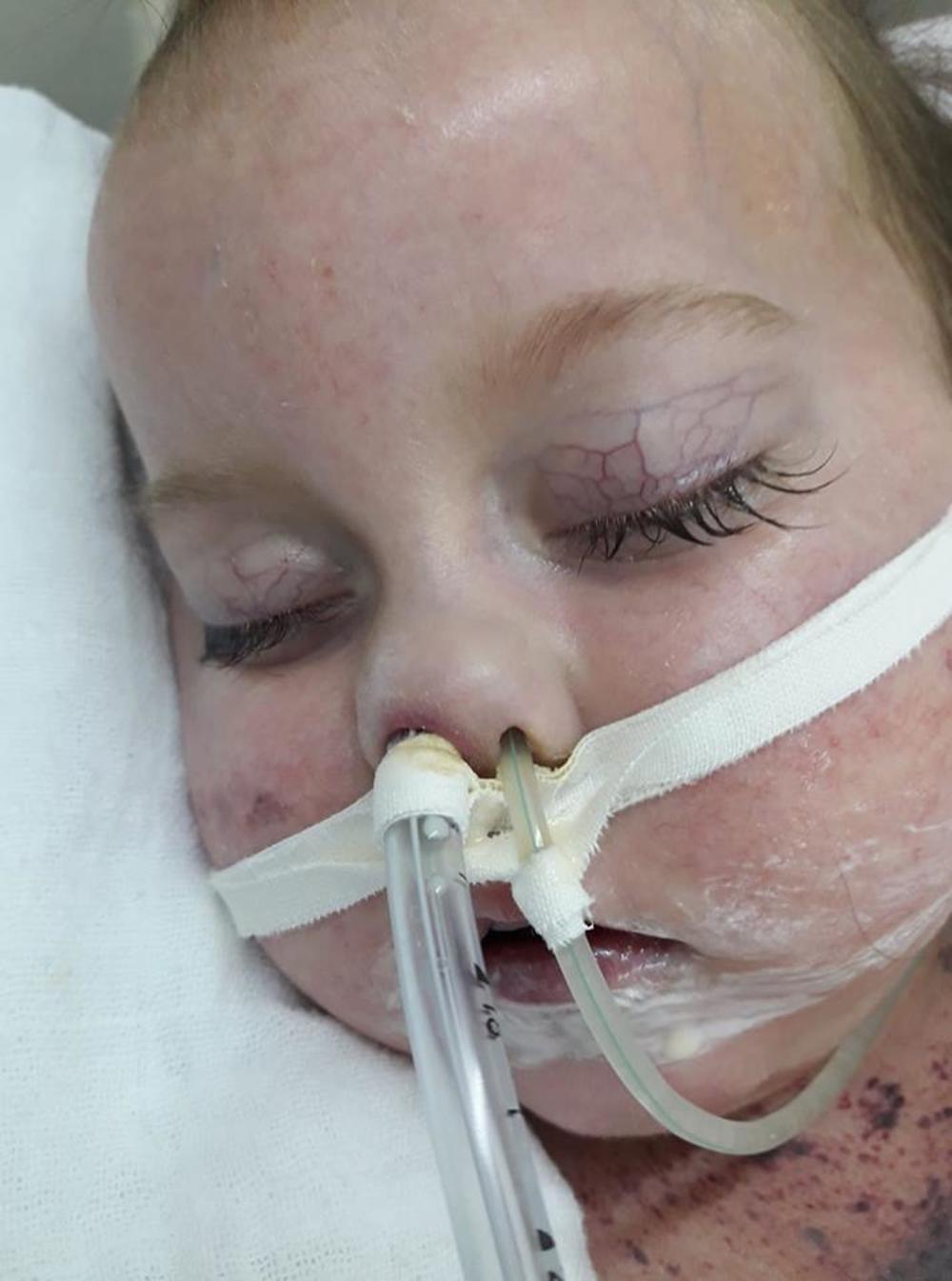 Mala Nađa nakon što se zarazila morbilama     