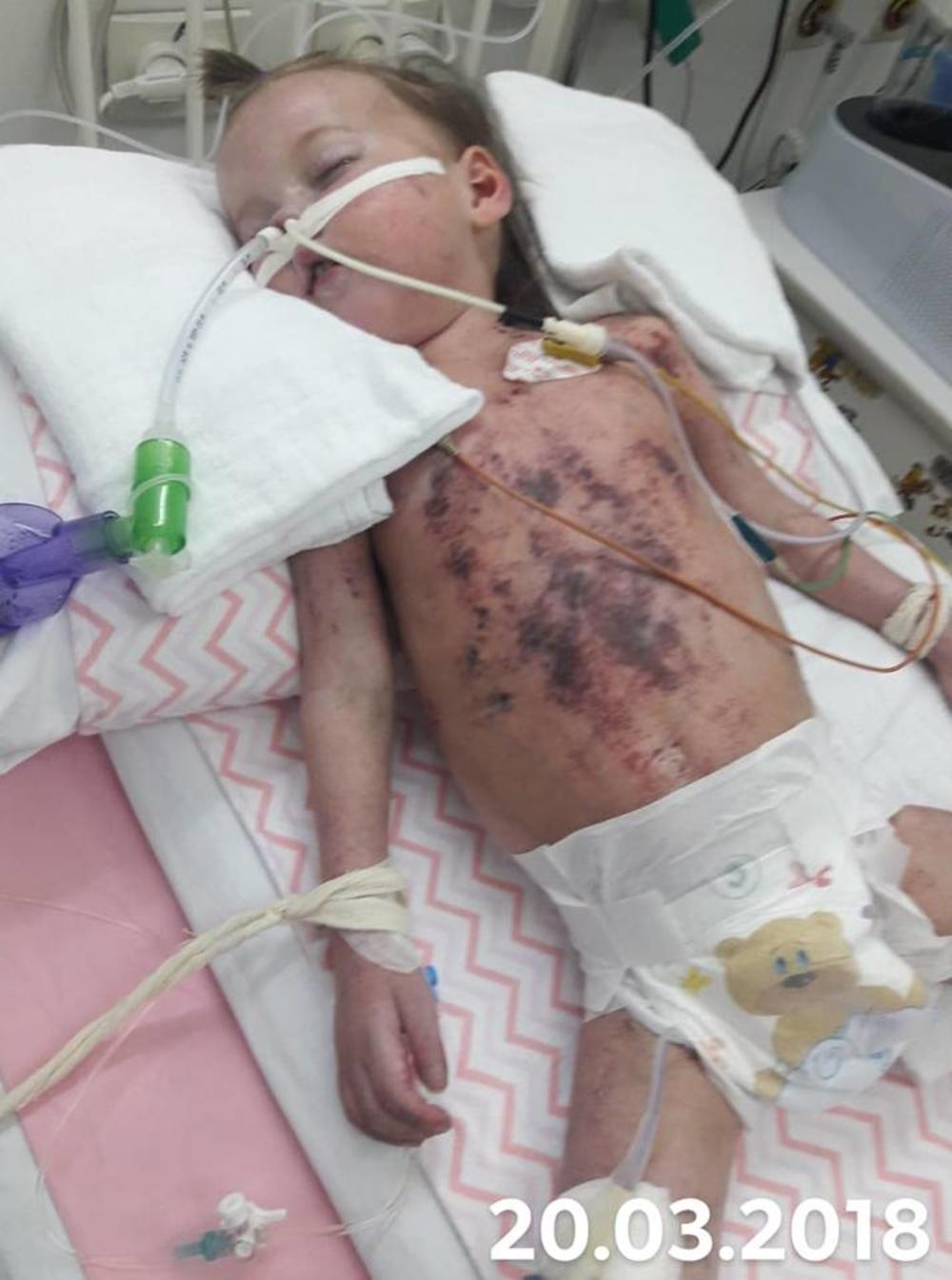 Mala Nađa se borila za život 3 meseca na aparatima  