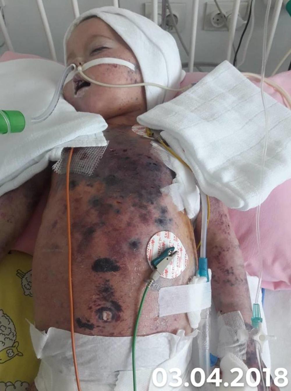 Mala Nađa se borila za život 3 meseca na aparatima     