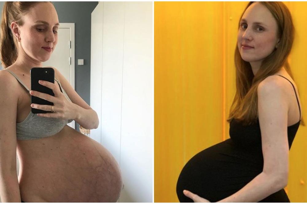 OVAKO IZGLEDA STOMAK KADA SE PORODI NEKO KO NOSI TROJKE: Marijine fotografije na Instagramu SVI žele da vide (FOTO)