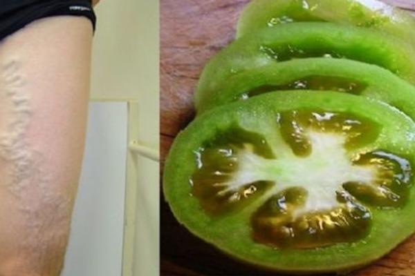 Ne možete da IZLEČITE proširene vene uz pomoć paradajza!