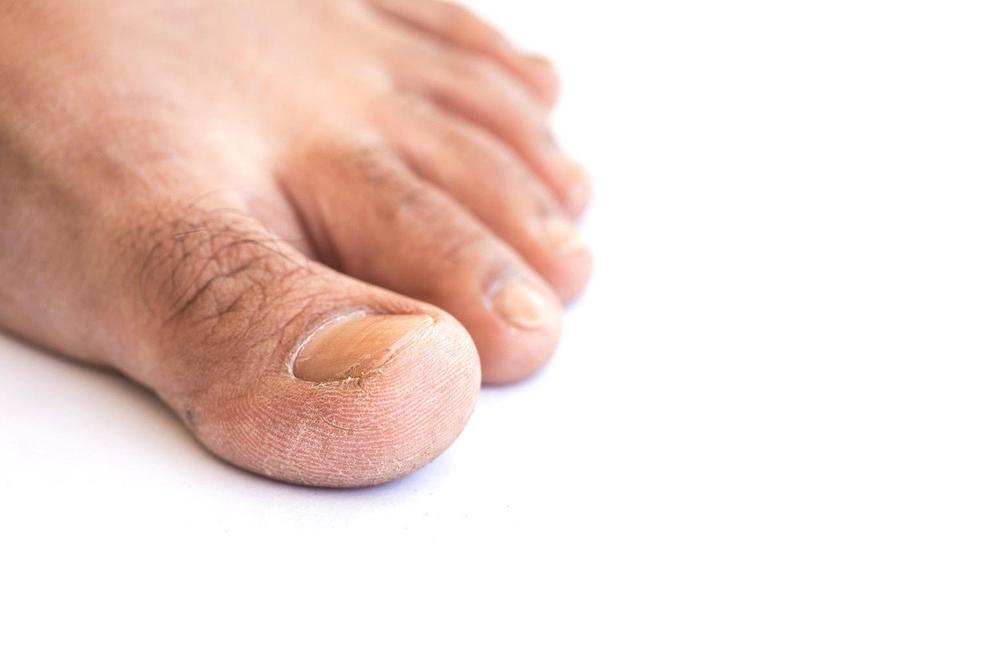 MUČI VAS URASLI NOKAT KOJI NIKAKO DA IZLEČITE: Ako vam se javio BOL i OTOK, evo rešenja koje deluje PREKO NOĆI