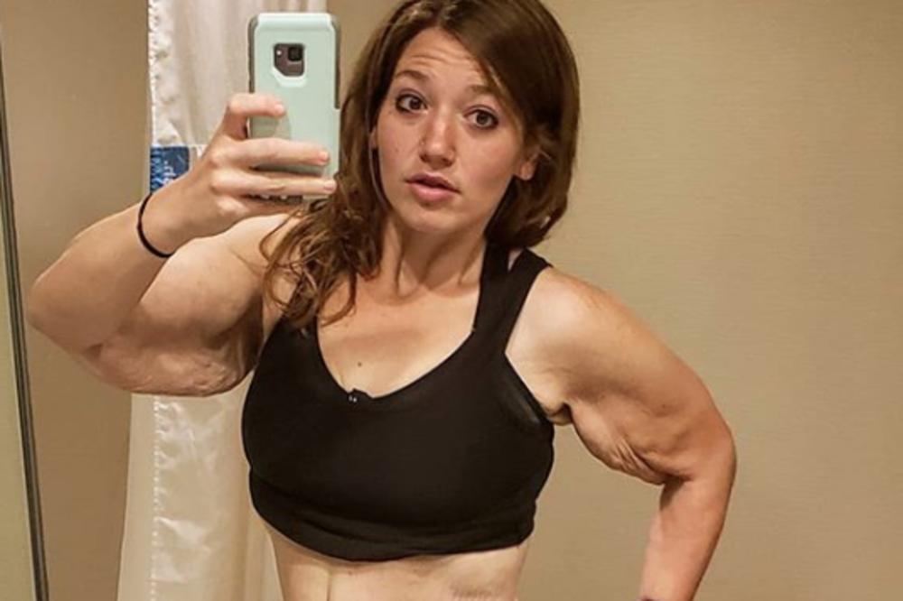 NAKON ŠTO JE SMRŠALA 140 KG, MORALA JE DA UKLONI 7 KG KOŽE: Ovo je najveća TRANSFORMACIJA koju ćete ikada videti!