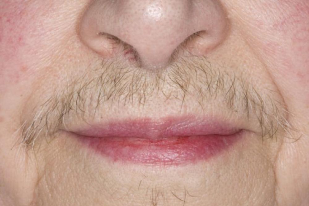 DLAČICE SA LICA NESTAJU PREKO NOĆI: Sve žene širom sveta su poludele za ČUDOTVORNIM RECEPTOM!