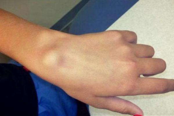 Ako uočite CISTU NA RUCI, znamo kako da je se rešite, ali i koji je UZROK NASTANKA