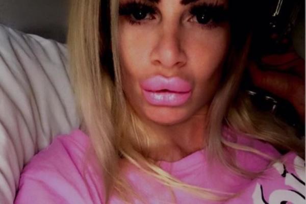 USNE MI IZGLEDAJU KAO ŽIVO MESO: Devojka je stavila FILERE I SADA ŽIVI U PAKLU! OVO JE PORUČILA SVIM ŽENAMA (FOTO)