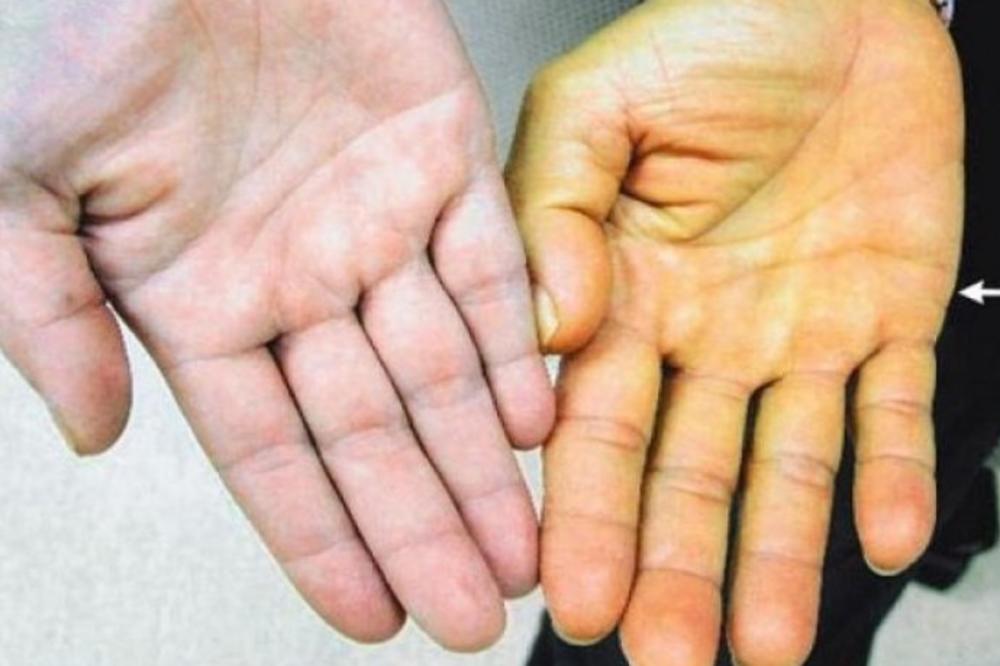 PRVI ZNAKOVI DA NEŠTO NIJE U REDU: Ovo su najraniji simptomi oštećenja JETRE koje ne smete da IGNORIŠETE