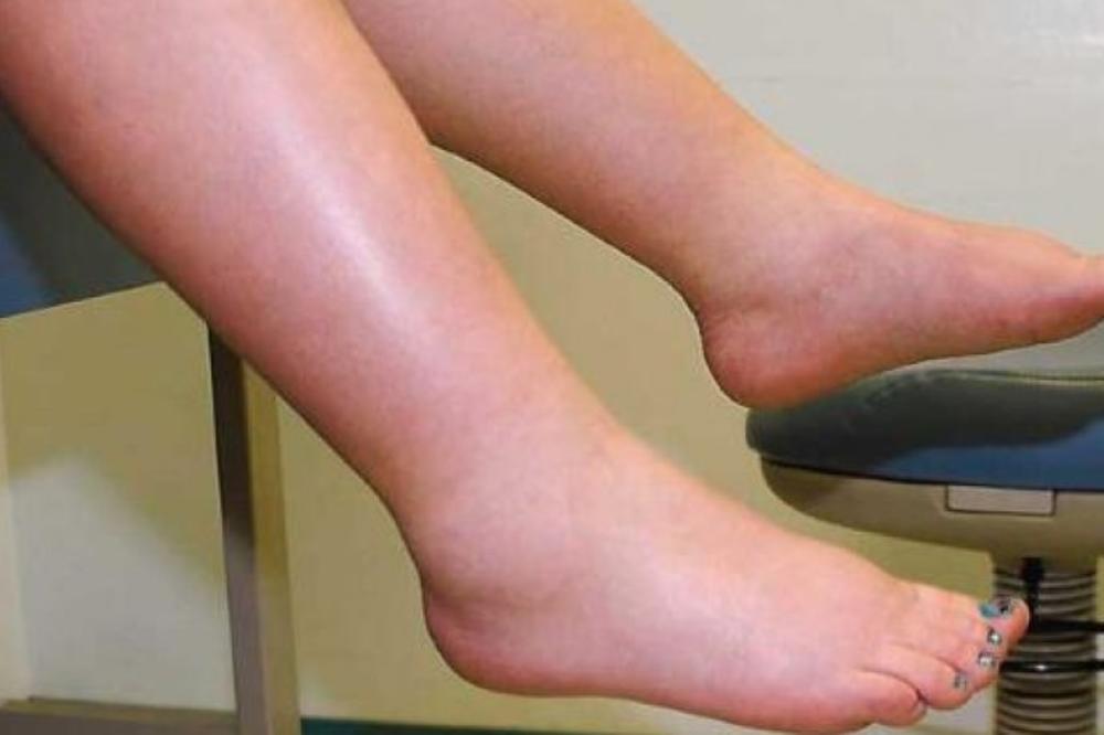 BEZ MUKE: Evo kako da se rešite  VODE iz organizma od koje izgledate mnogo deblje! ISPUMPAĆETE SE ZA DAN