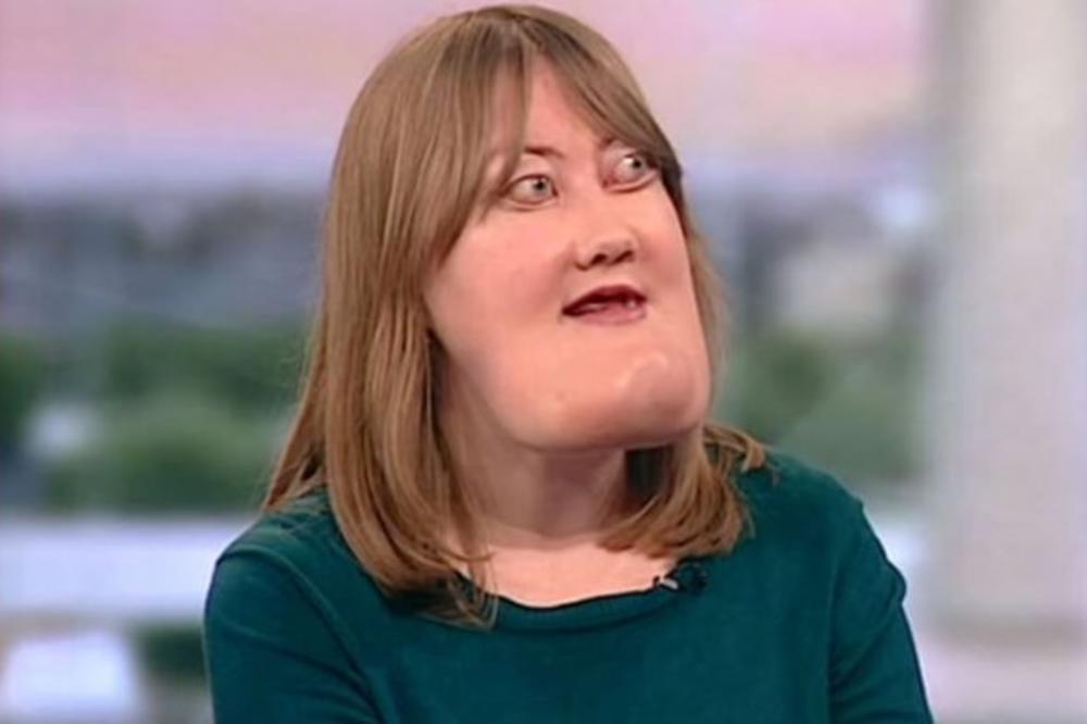 VIKTORIJA JE PROŠLA PAKAO OD ŽIVOTA ZBOG SVOJE BRADE: Lekari ostali u ČUDU kada su videli šta radi danas! (VIDEO)