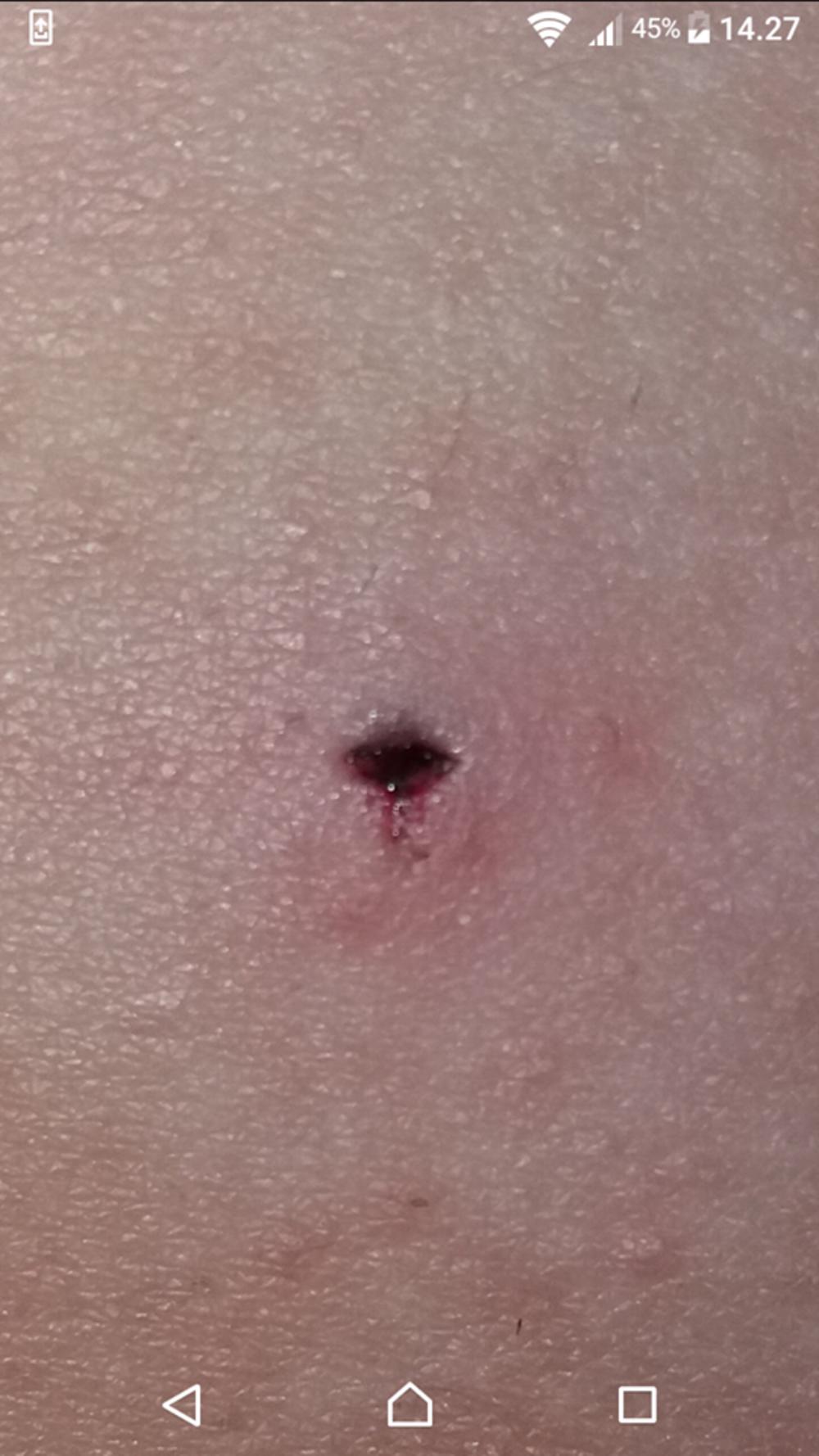 Povreda nastala od grafitne olovke  