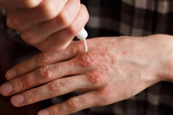 NIKAD NE BACAJTE KORU OVE VOĆKE: Leči psorijazu, hemoroide, skida bradavice, ali TO NIJE SVE!