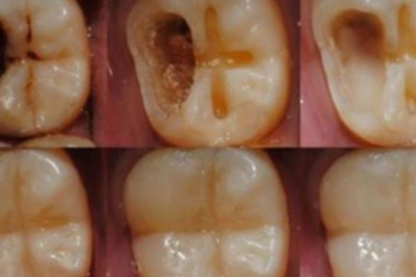 LEČITE ZUBE KOKOSOVIM ULJEM? Ovo morate znati