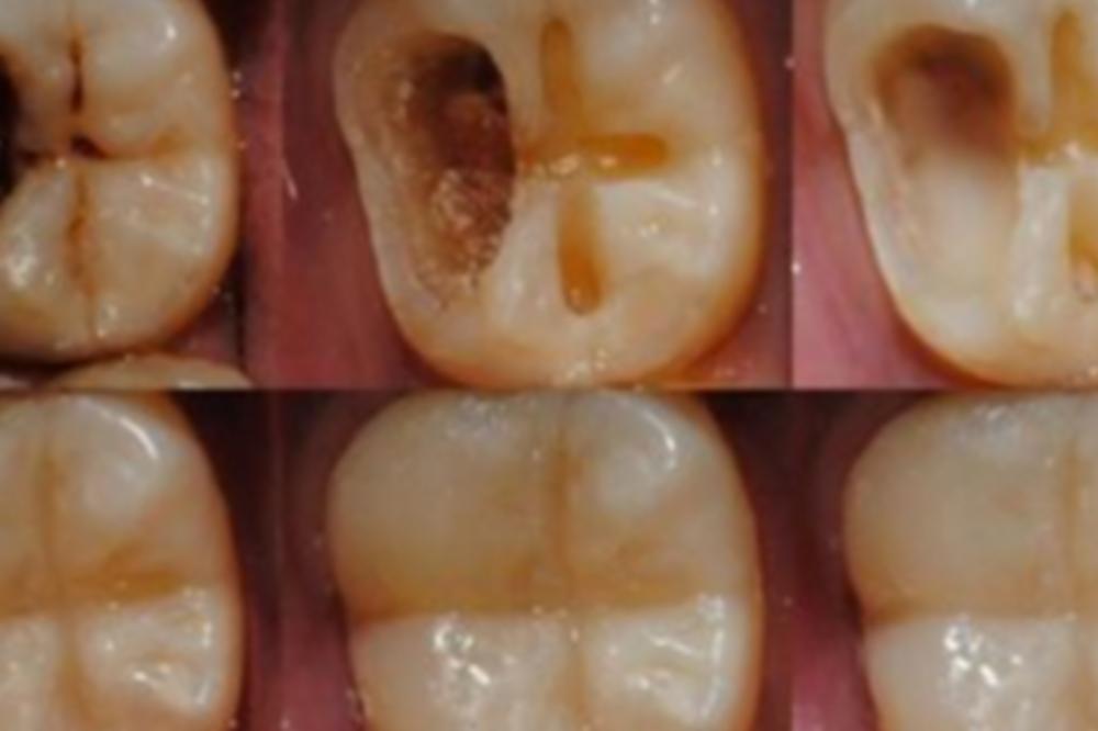 LEČITE ZUBE KOKOSOVIM ULJEM? Ovo morate znati