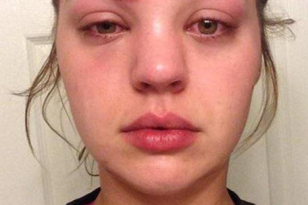 ISCEDILA JE BUBULJICU IZNAD OBRVE: Lice joj se momentalno IZOBLIČILO i to zbog STVARI koju koristi SVAKA ŽENA!