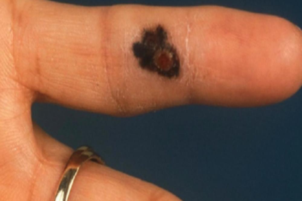 OTKRIJTE MALIGNU BOLEST NA VREME: Ovo je najčešći znak da u vama verovatno raste tumor!