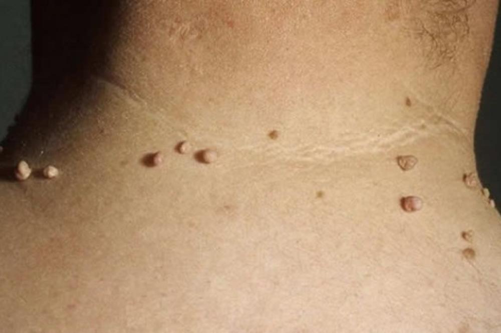 KAKO UKLONITI SVE BRADAVICE sa tela za nekoliko minuta koristeći JEDNU NAMIRNICU iz kuhinje!