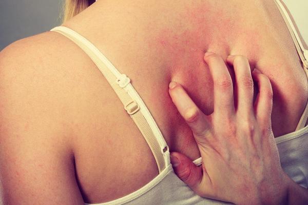 SRBI BIJU BITKU SA OVOM VRSTOM ALERGIJE, A NE ZNAJU DA VAM ZAPRAVO POMAŽE: Odlepićete na ovo