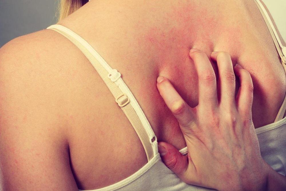 SRBI BIJU BITKU SA OVOM VRSTOM ALERGIJE, A NE ZNAJU DA VAM ZAPRAVO POMAŽE: Odlepićete na ovo