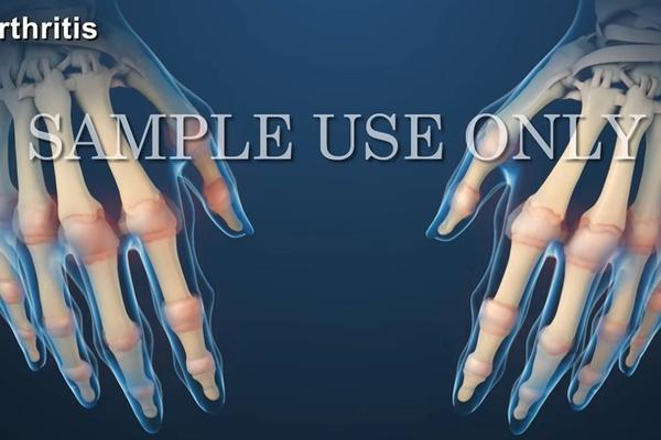 ISPRAVKA: Čaj od patlidžana nije lek za artritis