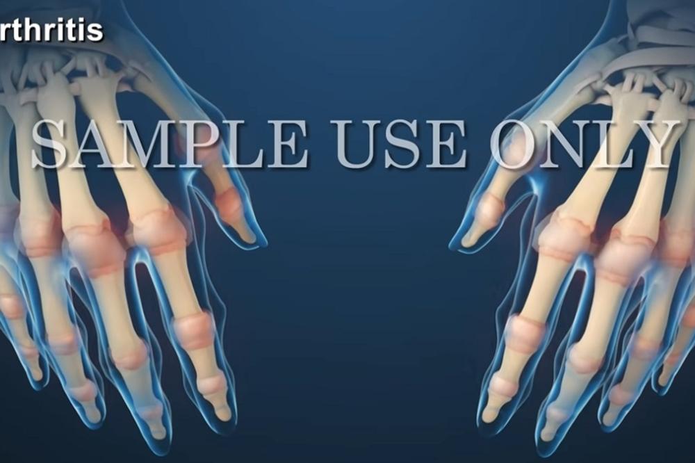 ISPRAVKA: Čaj od patlidžana nije lek za artritis