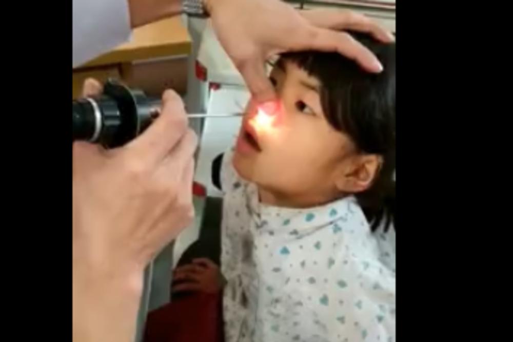 U NOSU DEVOJČICE JE ŽIVELO NEŠTO ODVRATNO! Lekar je bio šokrian kada je ugledao ovaj užas! (VIDEO)