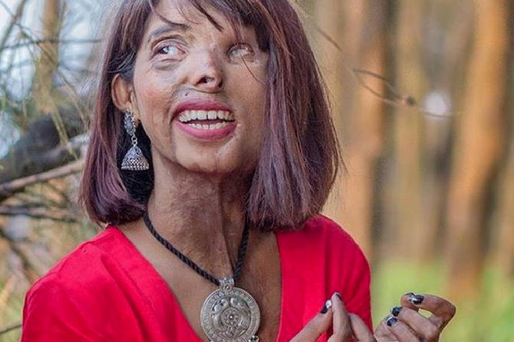 NJEN OTAC JE ŽELEO SINA, PA JU JE POLIO KISELINOM KAO BEBU! Ovako danas izgleda život ove nesrećne devojke (FOTO)