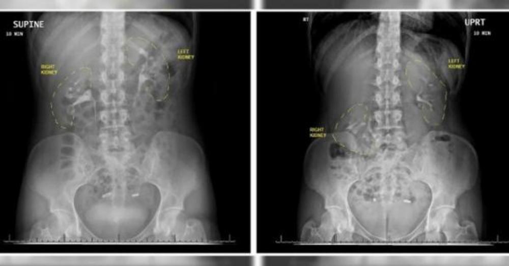 Žena je, naime, imala „lutajući bubreg“, odnosno nefroptozu, stanje u kome jedan od bubrega upadne u karlicu kada osoba ustane