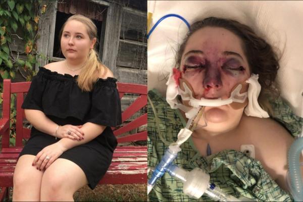 BILA JE SASVIM NORMALNA, A ONDA JE LICE POČELO DA JOJ OTIČE Oslepela je, a lekari PRVI PUT ČUJU za tu bolest (FOTO)